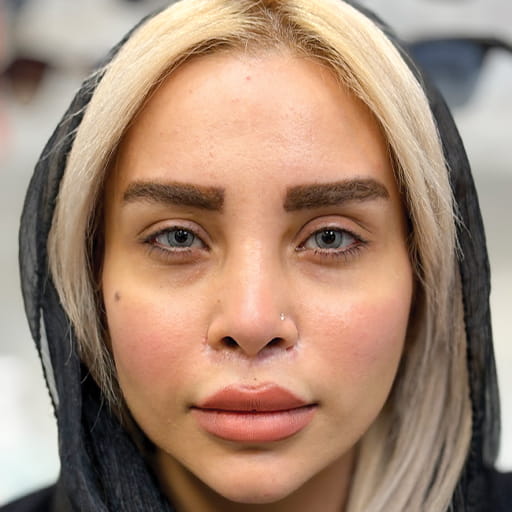 نتیجه کراتوپیگمنتیشن — خاکستری جادویی
