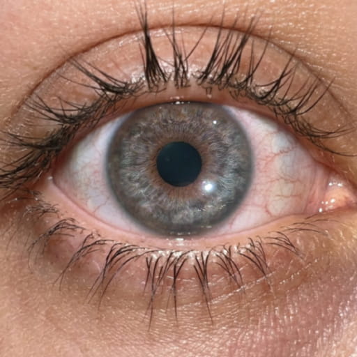 Laser eye procedure closeup