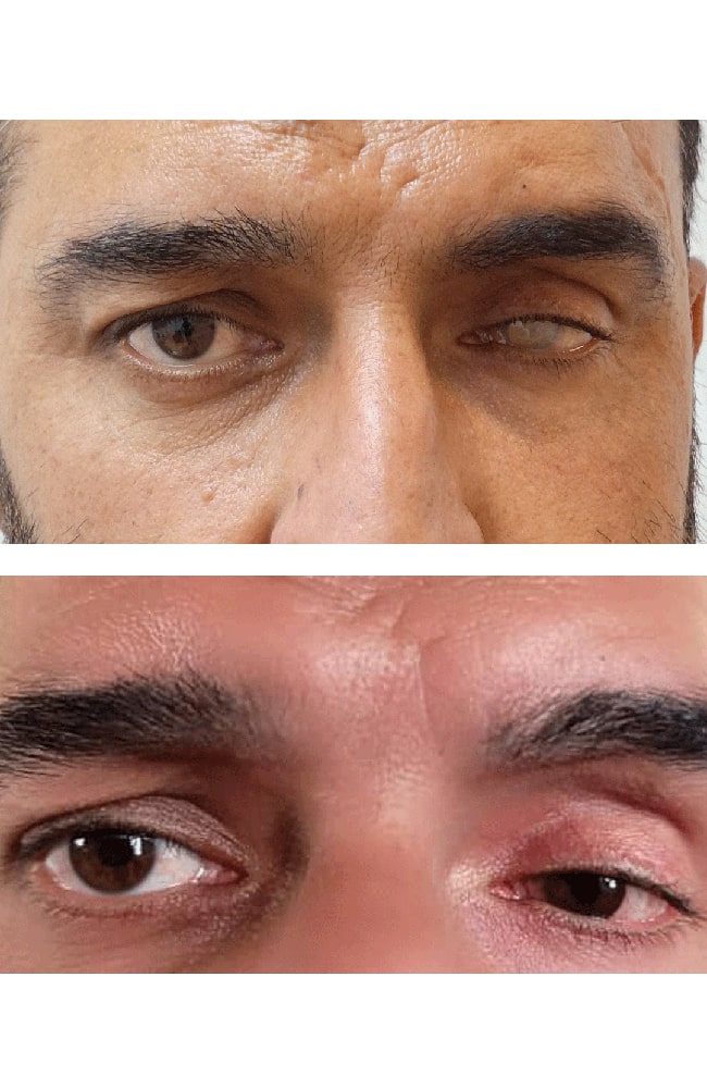 درمان تغییر رنگ چشم آسیب دیده