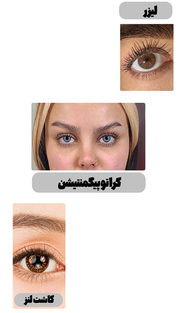 روش‌های مختلف عمل تغییر رنگ چشم