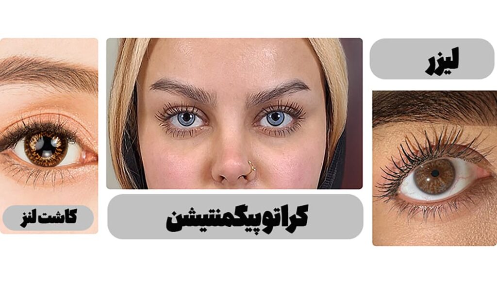 روش‌های مختلف عمل تغییر رنگ چشم