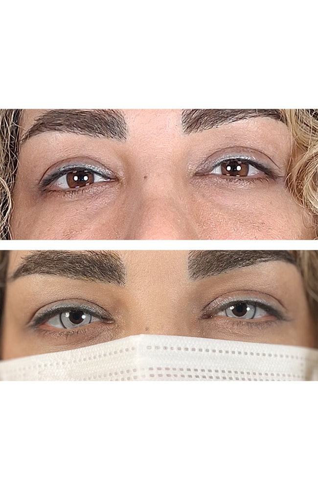 نمونه‌ای از نتیجه کراتوپیگمنتیشن در تغییر رنگ چشم