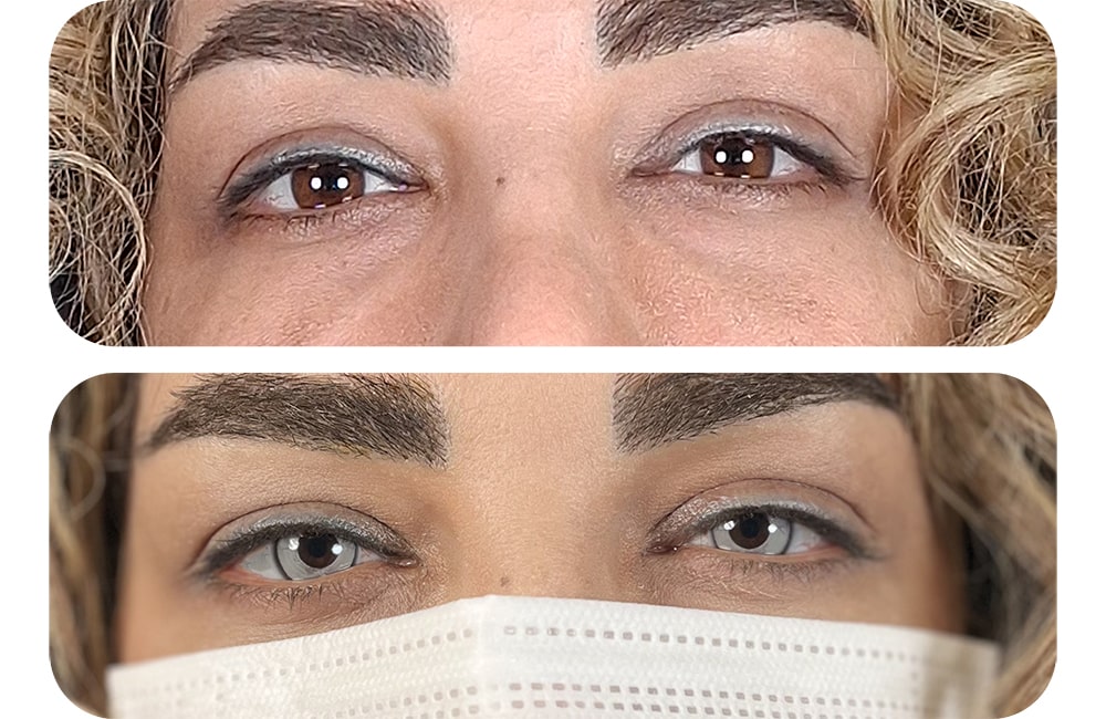 نمونه‌ای از نتیجه کراتوپیگمنتیشن در تغییر رنگ چشم