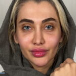نتیجه موفق و طبیعی جراحی تغییر رنگ چشم به رنگ لوکس دیپ بلو پس از عمل در کلینیک رویال آی کالر.