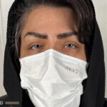 نتیجه موفق و طبیعی جراحی تغییر رنگ چشم به رنگ گرم و لوکس هانی گلد پس از عمل در کلینیک رویال آی کالر.