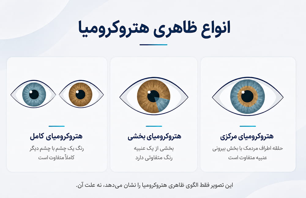 اینفوگرافیک انواع ظاهری هتروکرومیا شامل هتروکرومیای کامل، بخشی و مرکزی
