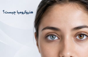 نمای نزدیک فردی با هتروکرومیا؛ یک چشم آبی‌خاکستری و چشم دیگر قهوه‌ای