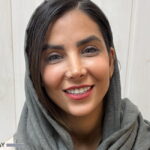 نتیجه تغییر رنگ چشم به خاکستری Magical Gray با کراتوپیگمنتیشن – کلینیک رویال