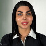 نتیجه تغییر رنگ چشم به خاکستری Magical Gray با کراتوپیگمنتیشن – کلینیک رویال