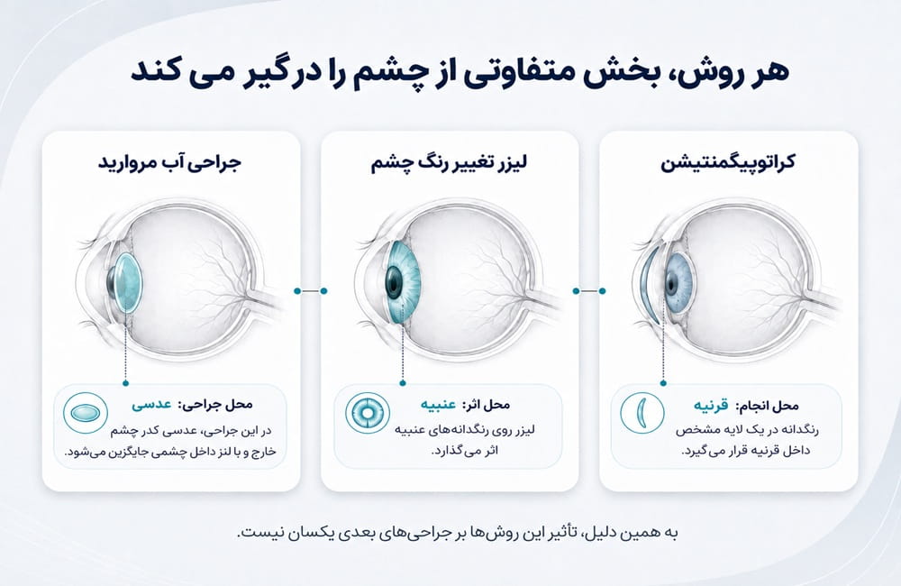 اینفوگرافیک مقایسه محل کراتوپیگمنتیشن در قرنیه، لیزر تغییر رنگ در عنبیه و جراحی آب مروارید در عدسی