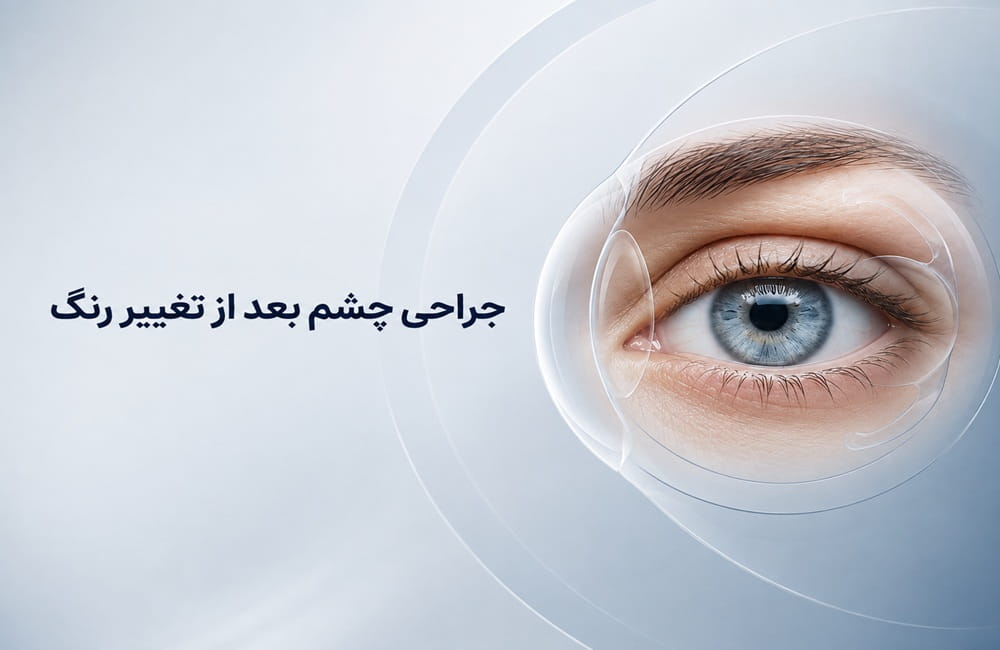 آیا بعد از تغییر رنگ چشم می‌توان لیزیک یا عمل آب مروارید انجام داد؟