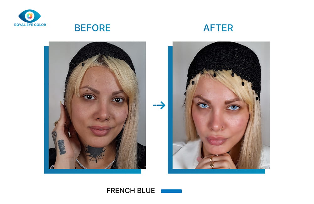 تصویر قبل و بعد کراتوپیگمنتیشن با تغییر رنگ ظاهری چشم از قهوه‌ای تیره به French Blue