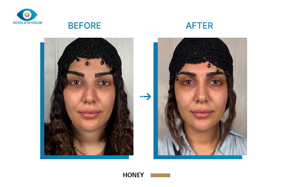 تصویر قبل و بعد کراتوپیگمنتیشن با تغییر رنگ ظاهری چشم از قهوه‌ای به عسلی Honey