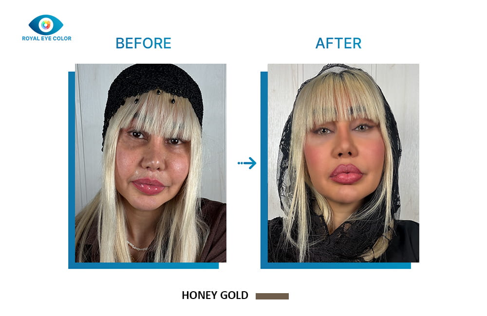 نمای ناحیه چشم در تصویر قبل و بعد کراتوپیگمنتیشن با رنگ عسلی طلایی Honey Gold
