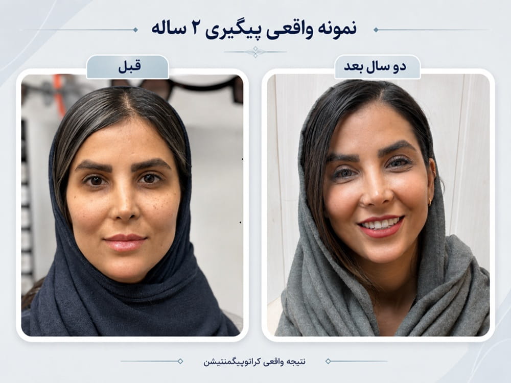 مقایسه تصویر واقعی یک مراجعه‌کننده قبل از کراتوپیگمنتیشن و دو سال بعد از تغییر رنگ چشم