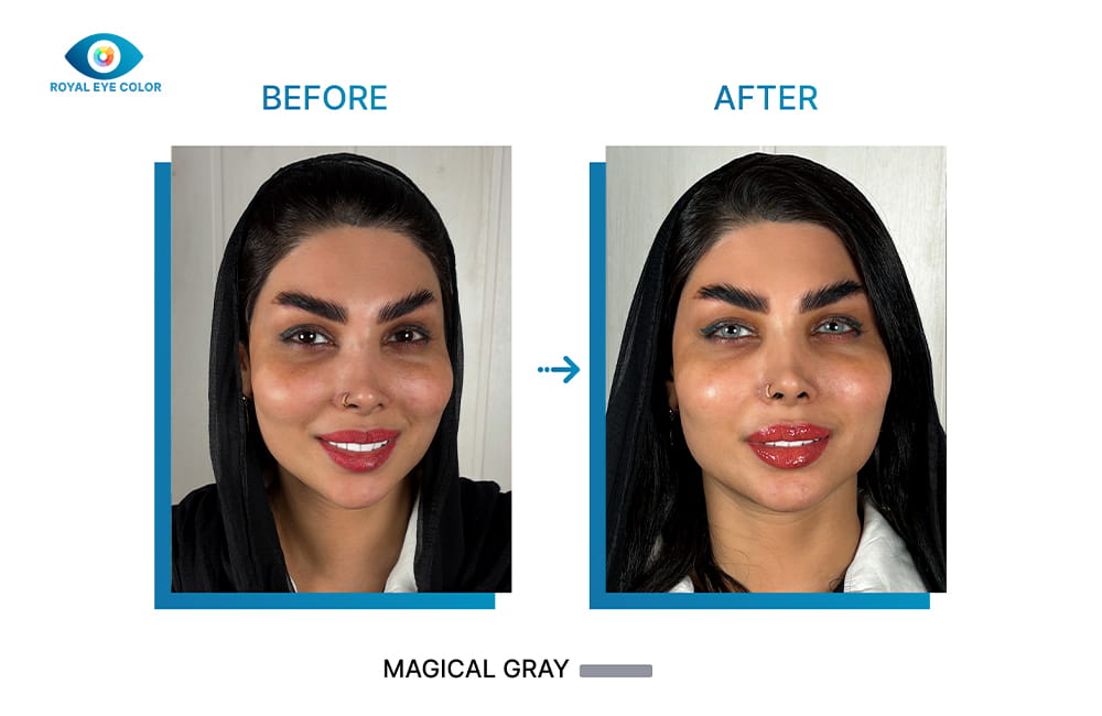 تصویر قبل و بعد کراتوپیگمنتیشن با تغییر رنگ ظاهری چشم از قهوه‌ای به طوسی Magical Gray